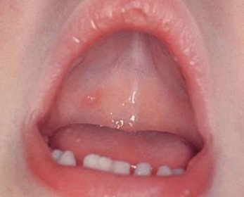 Plané neštovice v ústech dítěte: co léčit, jak se chovat a co dělat, jak bojovat