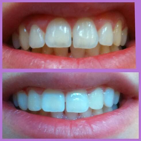 Before and After