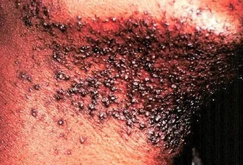 Picture of Razor Bumps
