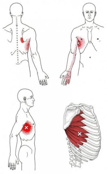 Bolest v boku - příčiny - Spoušťovýbod