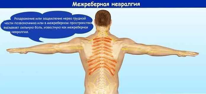 Interkostální neuralgie a domácí léčba / Neurologie | Užitečné informace a tipy na péči o sebe. Zdraví, výživa a další.