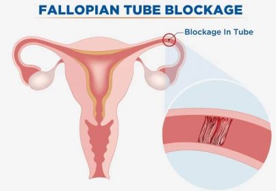 How to Get Pregnant with Blocked Fallopian Tubes