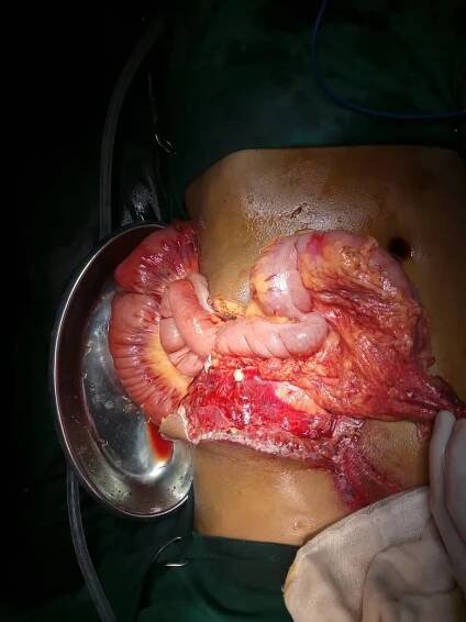 Intestinal Surgeon