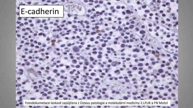 E-cadherin
Fotodokumetace laskavě zapůjčena z Ústavu patologie a molekulární medicíny 2.LFUK a FN Motol
 