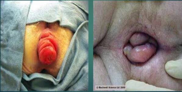 Rectal Prolapse and Haemorrhoid
