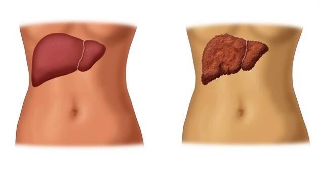 Vlevo zdravá játra, vpravo nemocná. Pokud není hepatitida C léčena, může vést k rozvoji cirhózy jater, případně až k rakovině jater.
