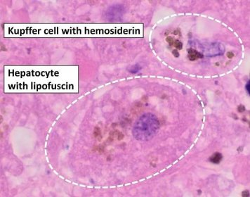 File:Kupffer cell with hemosiderin and hepatocyte with lipofuscin.jpg - Wikimedia Commons