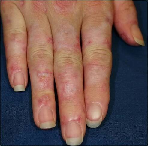 interphalangeal dermatitis.jpeg