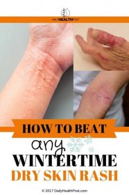 12 Home Remedies to Beat any Wintertime Dry Skin Rash