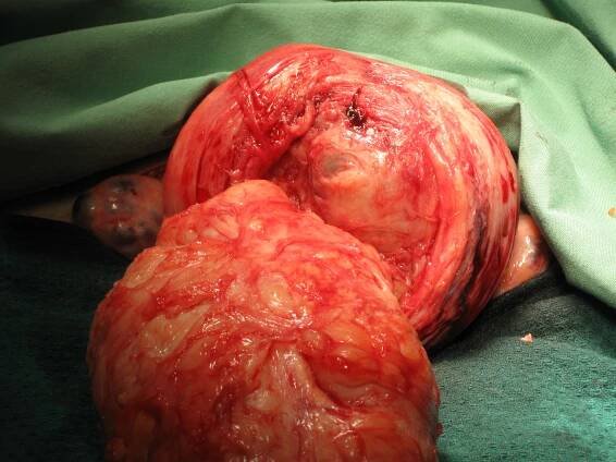 Myoma Large Myomectomy IVF