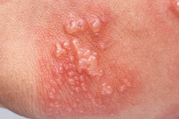 příznaky pásových oparů, zoster nebo herpes zoster na paži - dorsal nerve root - stock snímky, obrázky a fotky