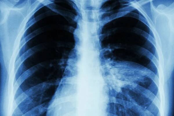 Pneumonie: příznaky, léčba, prevence a komplikace