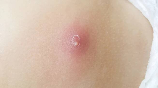 Abszess » Ursachen, Symptome & Behandlung
