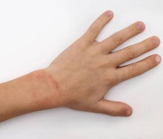 Červené skvrny na kůži rukou dítě pokryté krém. Příčinou je zimní chladné a větrné podmínky. Světle šedé pozadí. — Stock fotografie