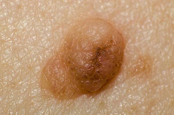 mateřské znaménko nebo papilom na kůži a těle člověka zblízka - hairy nevus - stock snímky, obrázky a fotky