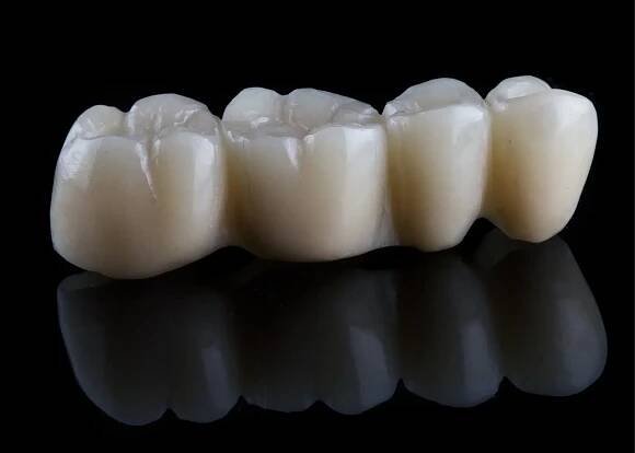 Celokeramický zubní můstek – porcelán a sklo-keramika e.max