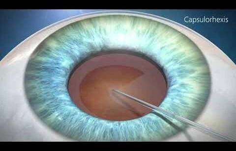 Cataract Surgery Animation