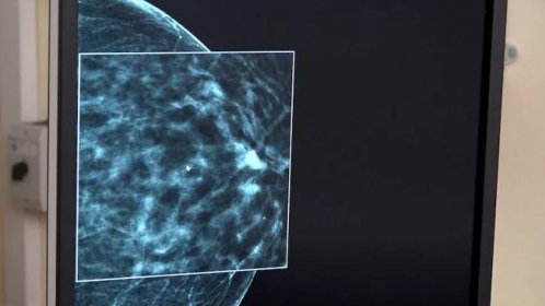 V boji proti rakovině prsu otestovali na Bulovce umělou inteligenci