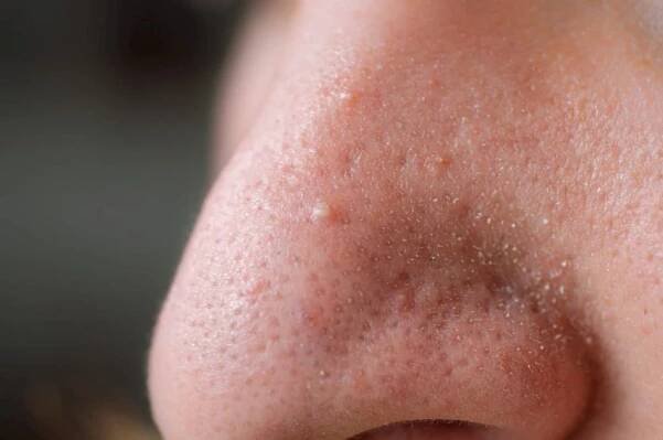 ucpané póry. problematická kůže. post-akné, jizvy a červené hnisající pupínky na tváři mladého muže. - melanoma face - stock snímky, obrázky a fotky