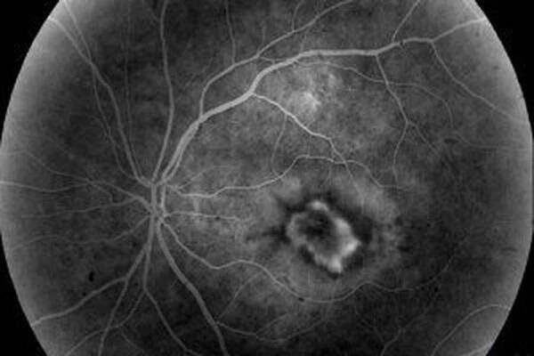 Chorioretinální dystrofie sítnice / Retina