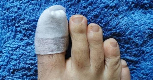Zlomený palec u nohy: Příznaky, léčba a rehabilitace pro urychlení hojení!