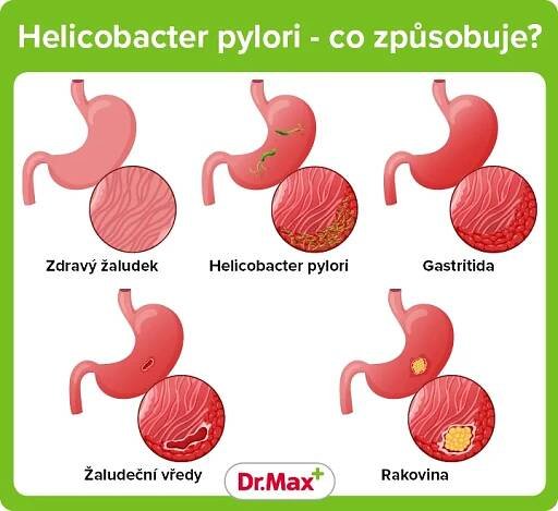 Helicobacter pylori – příznaky a léčba | Dr. Max