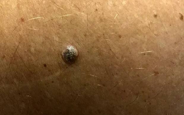 Most of Us Will Get Seborrheic Keratosis But What the Heck is It?