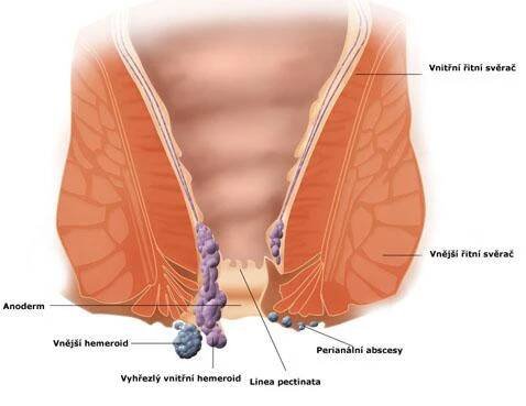 Hemoroidy | Cannapedia