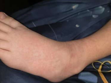 Alergie a ekzémy | Vyrážka nohy ruce