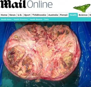 Žena ani netušila, že má v sebe viac ako 13-kilový nádor veľký ako melón | TVNOVINY.sk