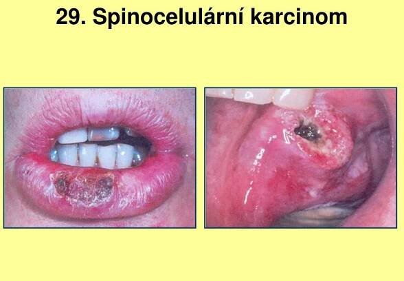 PPT - 21. Granulomy ústní sliznice PowerPoint Presentation, free download - ID:925540