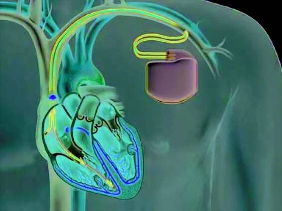Illustration of an implantable cardioverter-defibrillator.