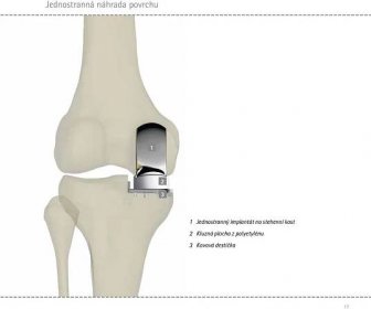 artróza kolene invalidní důchod