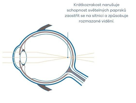 České děti čelí epidemii krátkozrakosti. Záchranou jsou speciální brýlové čočky
