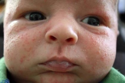 Vyrážka bez horečky - novorozenecké akné