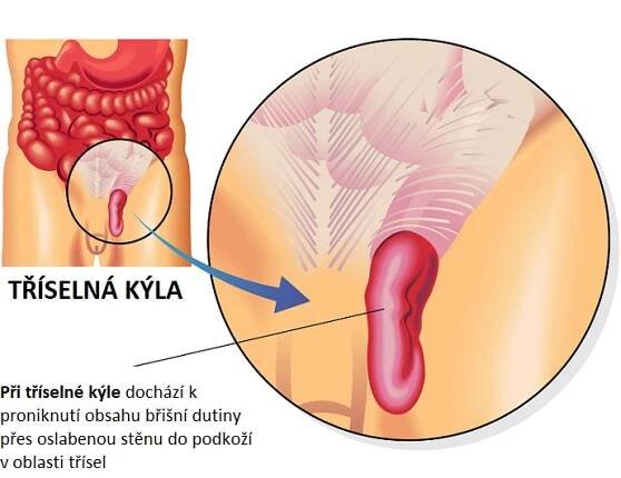 Tříselná kýla - ilustrace - Při tříselné kýle dochází k proniknutí obsahu břišní dutiny přes oslabenou stěnu do podkoží v oblasti třísel