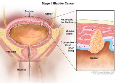 Stupeň II rakoviny močového měchýře