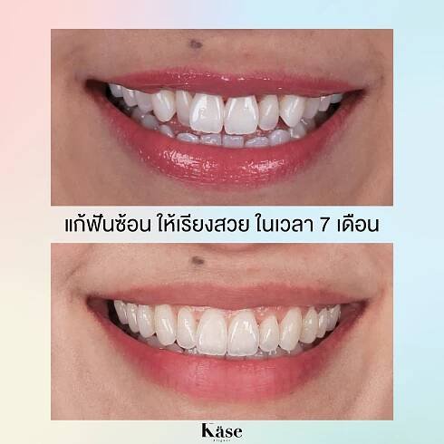 Cases - kasealigner