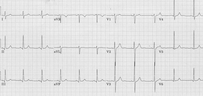 ECG normal q wave and sinus rhythm