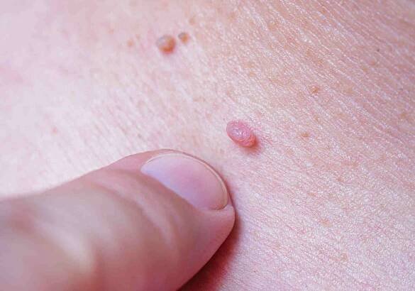 velký papilom nebo bradavice na kůži člověka, přirozený stav. lidský papilomavirus (hpv). - papilom - stock snímky, obrázky a fotky