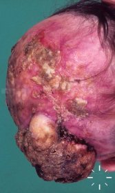 DermaCompass - Squamous cell carcinoma of the skin (spinocellular carcinoma, SCC) 