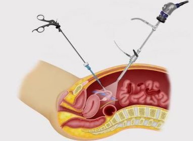 Laparoskopie - operace k odstranění ovariální cysty