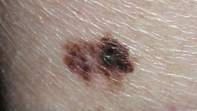 Raised Skin Bump: 25 Causes, Photos, & Treatments – Healthline 