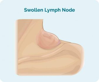Zduření lymfatických uzlin je často prvním příznakem lymfomu. To se projevuje jako bulka na krku, ale může být také v podpaží, tříslech nebo kdekoli jinde na těle.