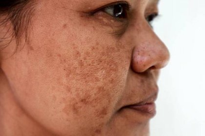 Co znamenají tmavé skvrny na kůži a tvoří problém?