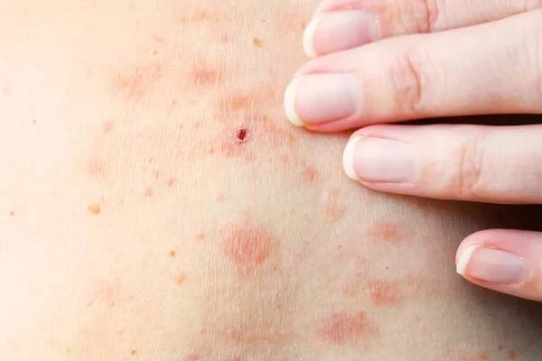 Kožní vyrážka léčba na těle ženy. pásový opar, choroba, herpes zoster, virus varicella-zoster. kožní vyrážka a puchýře na těle — Stock obrázek