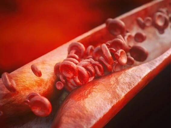 atherosclerosis-01