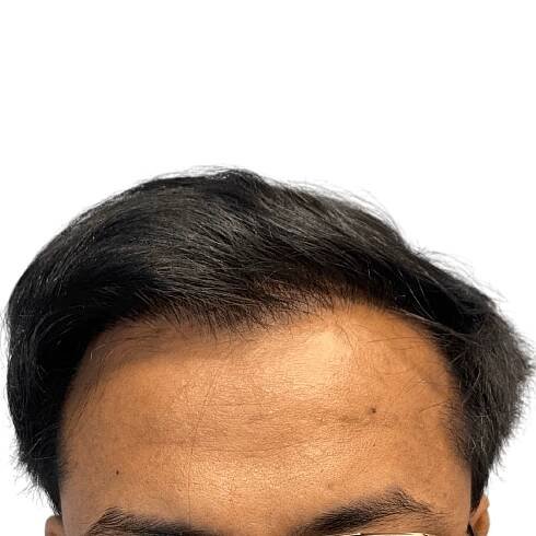No.1 Hair Transplant Clinic in Ahmedabad | Dr. Aanchal Shah | Zeeva Clinic