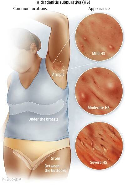 Hidradenitis Suppurativa Diagram