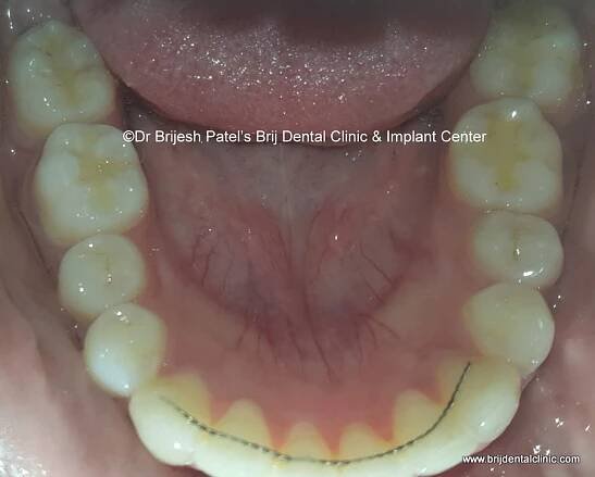 After Alignment with Braces